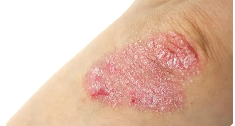 Psoriasis and food triggers - tracking dietary causes of skin flares